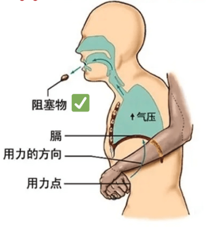 参考海姆立克腹部冲击法，自助咳痰